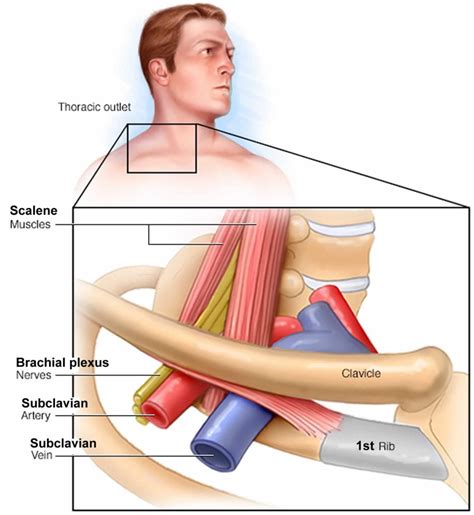 Thoracic Outlet Syndrome Causes Symptoms Diagnosis Exercise And Treatment