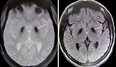 Scielo Brasil A Diagnostic Approach For Neurodegeneration With