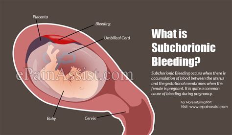 What Is Subchorionic Bleeding And How Is It Treated Causes Symptoms