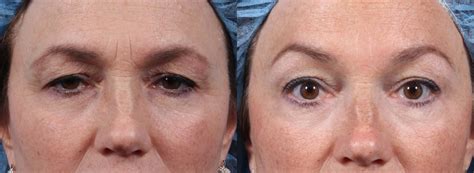 Brow Lifts Nyc Dr Brett Kotlus Cosmetic Oculoplastic Surgeon