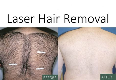 Laser Hair Removal Pinnacle Dermatology