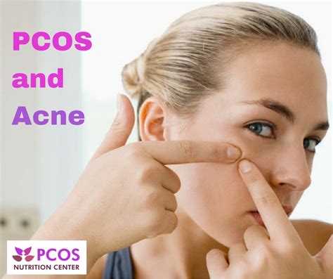 Akne, kıl köklerinin ve yağ bezlerinin (deri altındaki yağ üreten bezlerin) tıkanmasıyla sonuçlanan ve sivilcelere neden olan yaygın bir cilt durumudur. PCOS and Acne: Natural Treatment Options - PCOS Nutrition ...