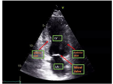 Figure Apical Two Chamber View On Transthoracic Echocardiography
