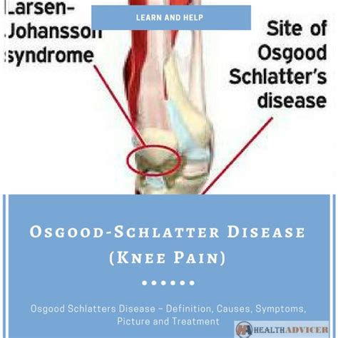 Osgood Schlatters Disease Adult