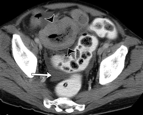 Primary Gastrointestinal Lymphoma Spectrum Of Imaging Findings With