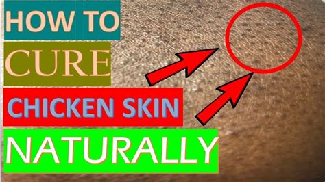 8 Effective Chicken Skin Treatments You Can Apply Today Youtube