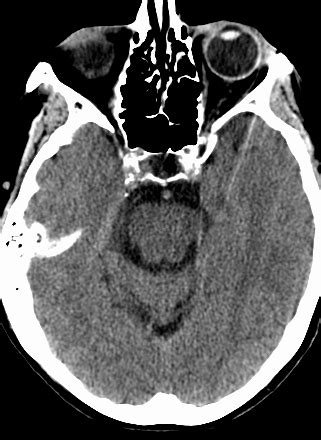 A ct scan is usually one of the first tests done in a stroke evaluation, particularly during an acute stroke in the emergency room. A Normal Head CT Scan Does Not "Rule Out" Ischemic Stroke ...