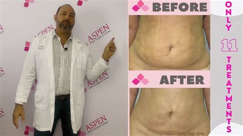 Liposuction Fibrosis Treatment Soften And Smooth Lumps And Bumps Youtube