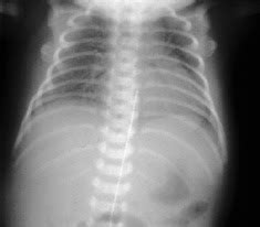 This substance helps the lungs fill with air and keeps the air sacs from deflating. Hyaline Membrane Disease (HMD) - Nursing Care Plan - NANDA ...