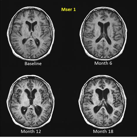 Multiple Sclerosis Research End Organ Damage Mri Grey Matter Atrophy