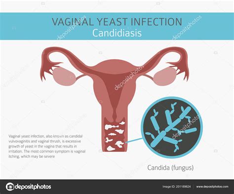 Infección Vaginal Por Levaduras Candidiasis Infografía Ginecológica