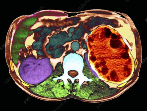 Kidney Cancer Ct Scan Stock Image M1340845 Science Photo Library