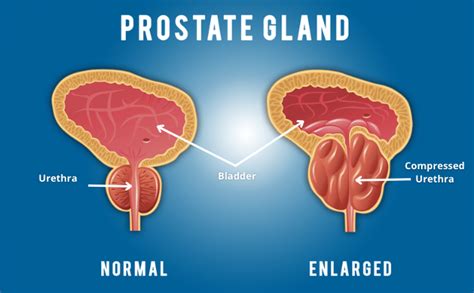 What You Should Know About Prostate Cancer
