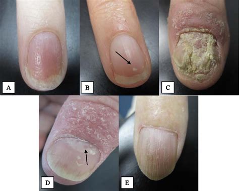 Figure 1 From Psoriatic Arthritis And Nail Changes Exploring The