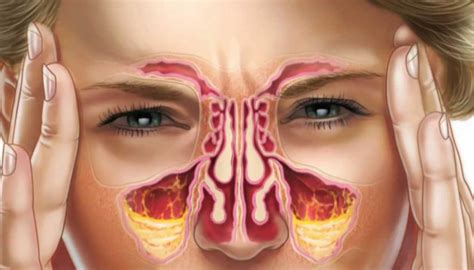 How To Clear Sinuses Pressure Points 5 Tips To Relieve Sinus
