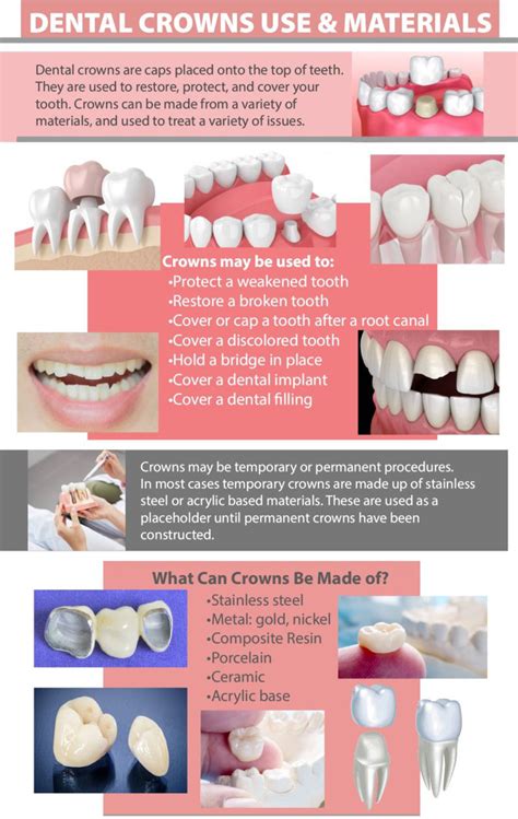 5 Important Things You Should Know About Dental Crown Procedure