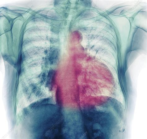Cardiomyopathy Chest X Ray Stock Image C0533897 Science Photo