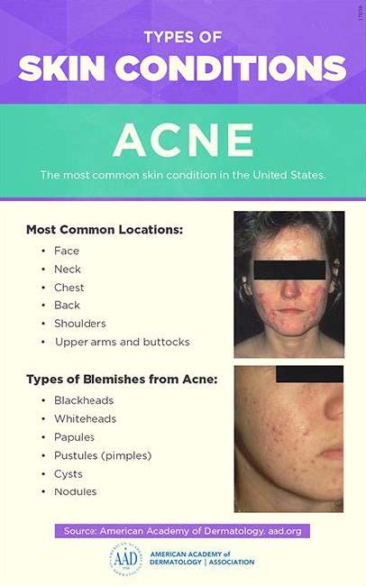 Acne Diagnosis And Treatment Dermatology Surgery Center Niceville