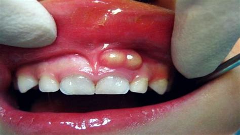 اسباب نزول اللثة عن الاسنان