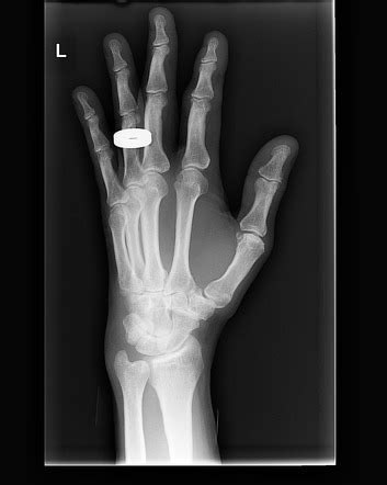 Distal Phalanx Fracture Radiology Reference Article Radiopaedia Org