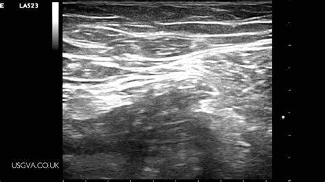 Ultrasound Guided Femoral Nerve Block Youtube