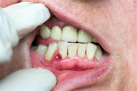 All About Gum Abscesses Online Dental Care