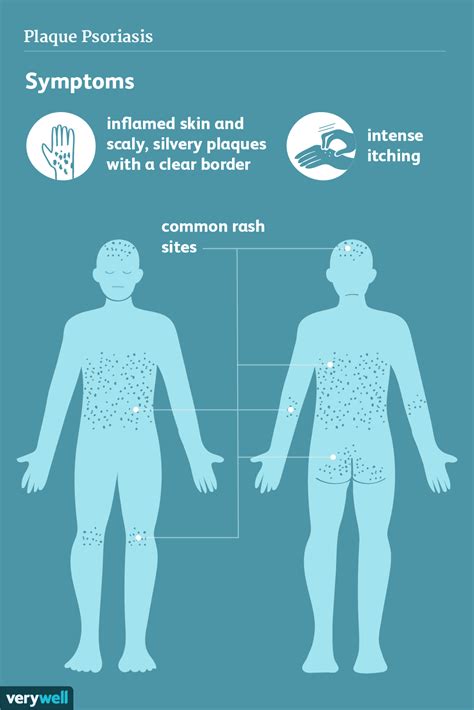 Signs And Symptoms Of Plaque Psoriasis