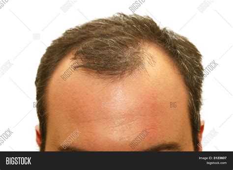 Balding Head Image And Photo Free Trial Bigstock