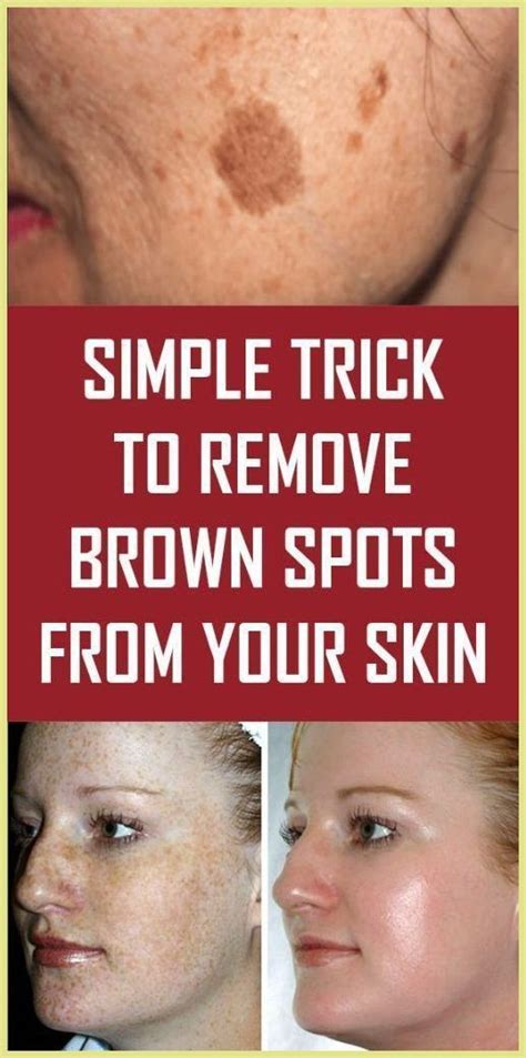 Simple Trick To Remove Brown Spots From Your Skin Spots On Face Brown Spots Removal Brown