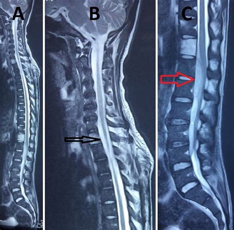 Cureus Spinal Epidural Abscess In Melioidosis A Rare Case Report