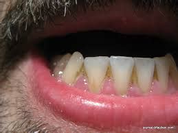 Maybe you would like to learn more about one of these? How to Get Rid of Brown Stains In Between Teeth ...