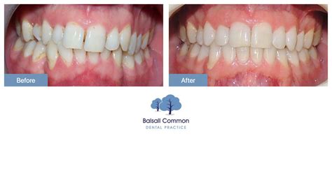 Braces And Gum Recontouring Balsall Common Dental Practice