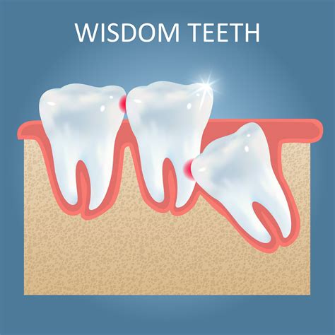 Word To The Wise What Parents Need To Know About Wisdom Teeth Bowie