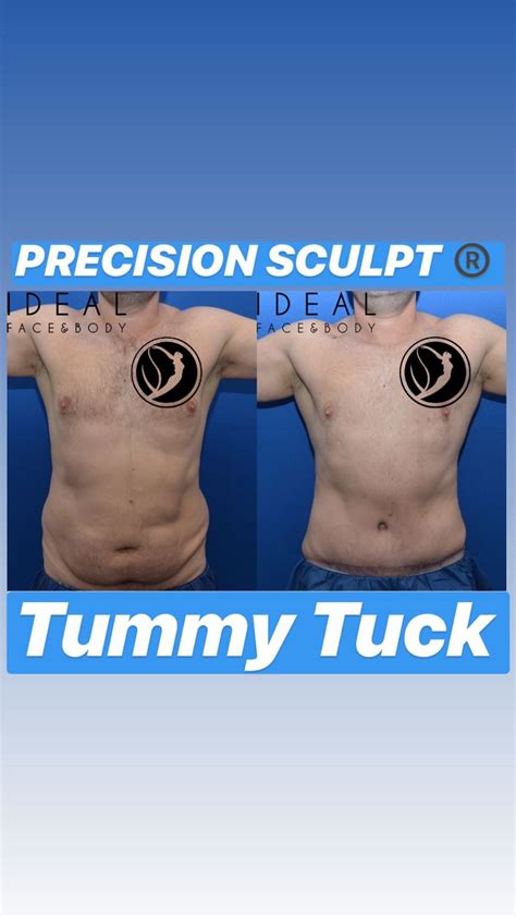 Male Tummy Tuck Tummy Tucks Tummy Face And Body