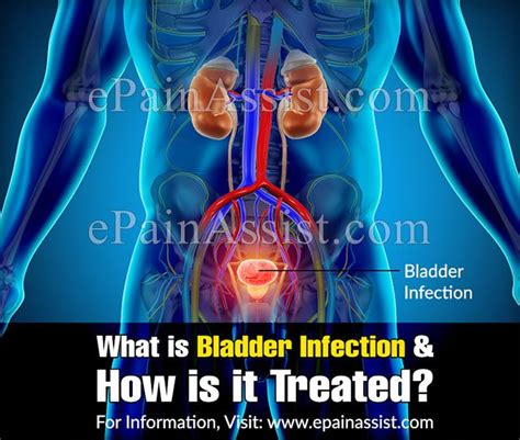What is Bladder Infection & How is it Treated? | Bladder ...