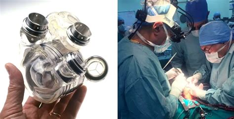 Lebanon Just Recorded Its First Successful Artificial Heart Transplant