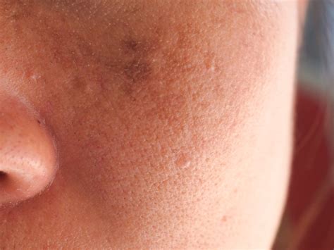The Differences Between Melasma And Typical Hyperpigmentation And How