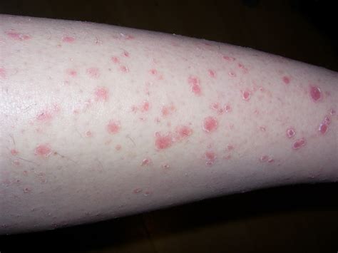 Itchy Red Spots On Arms