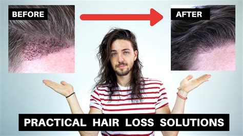 Practical Hair Loss Solutions For Men At All Stages Of Hair Loss