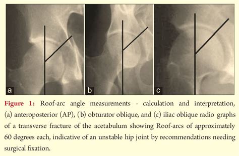 Decision Making In Acetabulum Fractures When To Operate And When Not