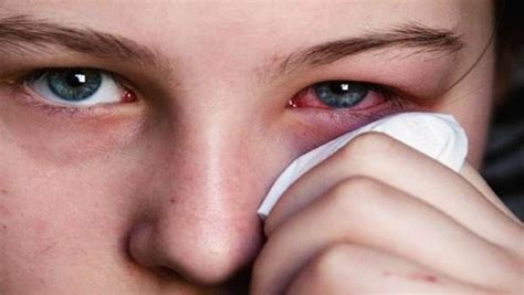 24 Tips How To Treat Red Eyes At Home Without Eye Drops Pink Eye
