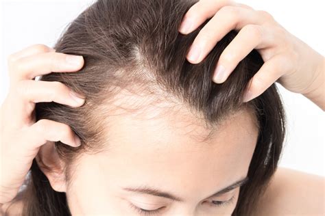 Preventing Hair Loss Due To Iron Deficiency Pharmics Inc