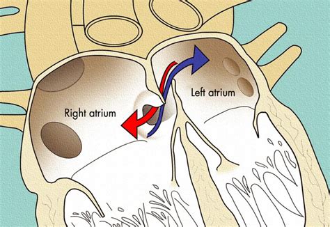 Patent Foramen Ovale Causes Symptoms Diagnosis Treatment