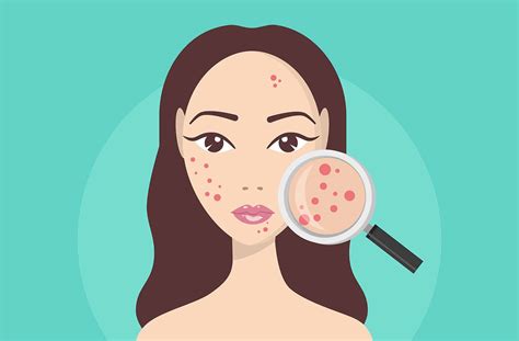 What Causes Cystic Acne And How To Treat It Effectively Sl Aesthetic