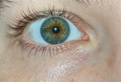 My Moms Eye Is This Central Heterochromia Heterochromia