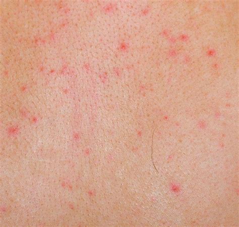 What Are The Different Types Of Dry Skin Rashes