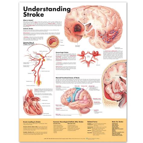 Understanding Stroke Anatomical Chart 2nd Edition 20 X 26