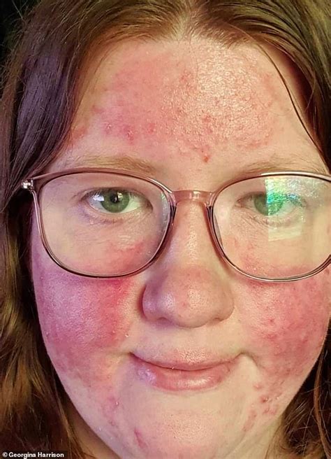 Rosacea Sufferer Claims £1995 Concealer Made With Capers Improved Her
