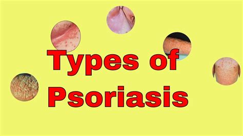 Types Of Psoriasis Plaque Guttate Pustular Inverse