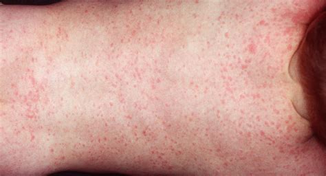 What Causes Roseola In Adults